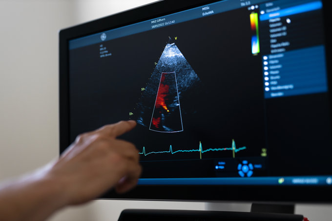 Dies ist eine Bildschirm-Abbildung einer Transösophagealen Echokardiografie.